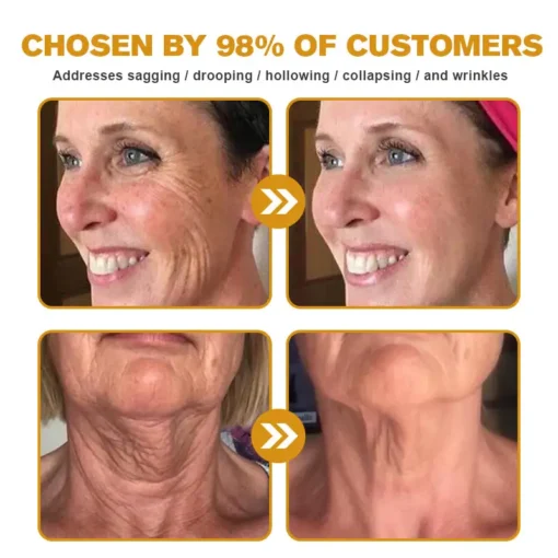 𝗧𝗟𝗢𝗣𝗔® Botox Bee Venom Wrinkle Removal Cream